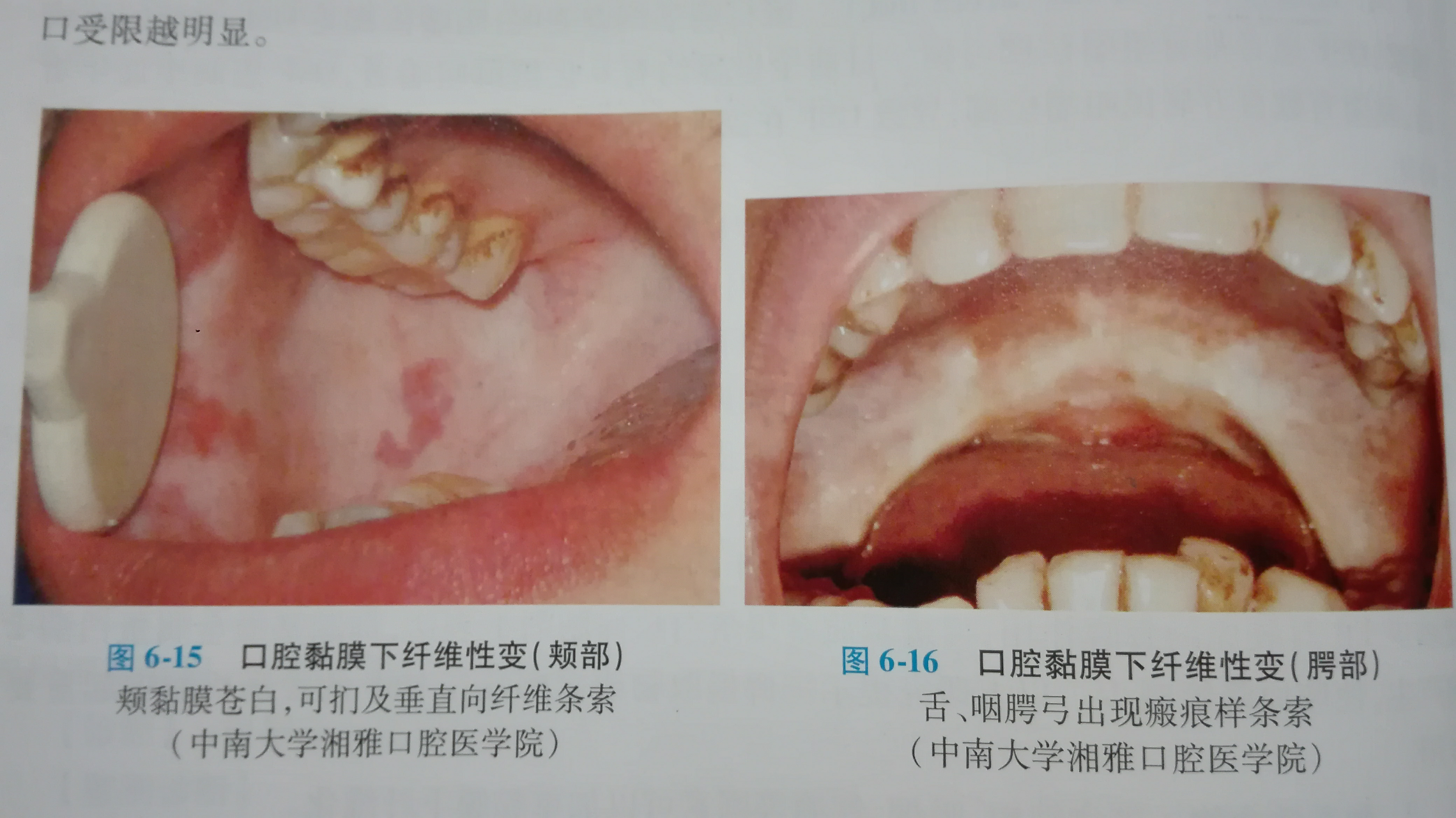 吃槟榔得了口腔黏膜纤维化怎么办