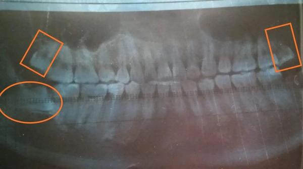 从拔了一颗横着长的智齿中恢复过来,今天满血复活的我,又去拔了上方