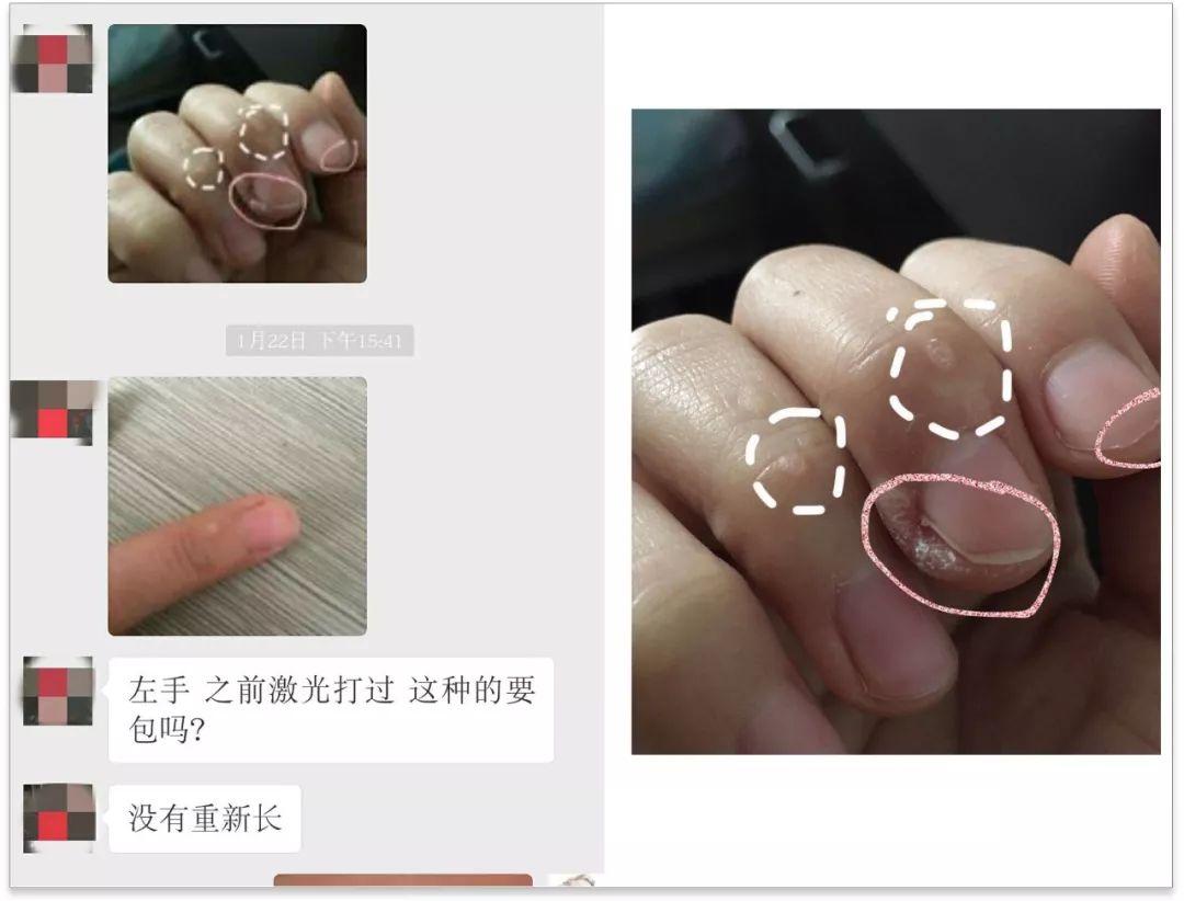 你不得不看的甲疣30经典案例