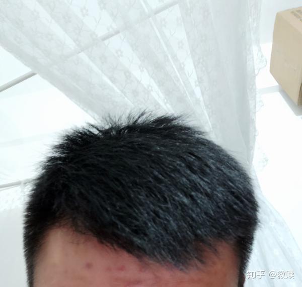 我的头发开始慢慢变好,发际线现在长出很多短头发,从之前