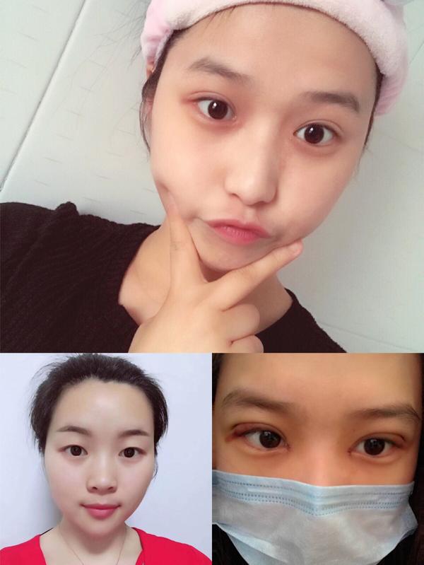 首先考虑的问题是做什么样的双眼皮才好看