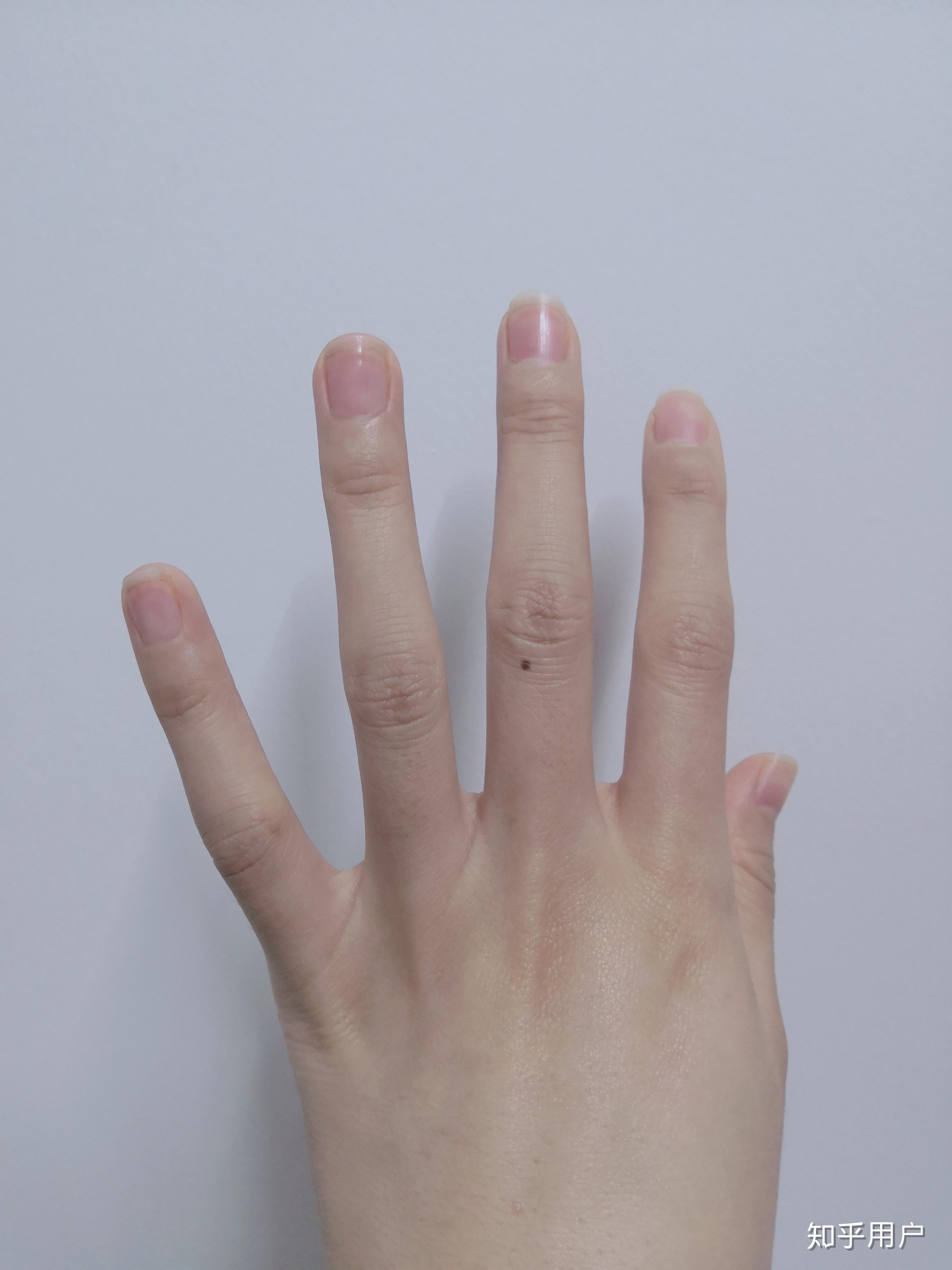 女生右手中指突然长了个小痣代表什麼