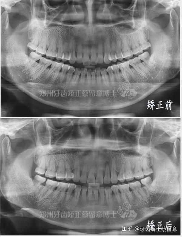 嘴突 长期口呼吸,嘴唇放松状态下嘴巴不能自然闭合,还存在个别牙齿