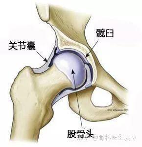 的早期髋关节发育不良患者,症状刚开始不是很严重,先建议保守治疗方案