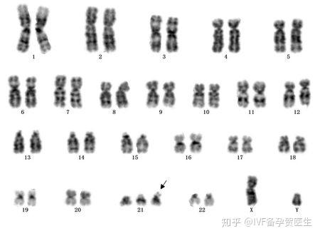 "缺失"是指某染色体中的一段为单倍体,"重复"是指某染色体中的一段为