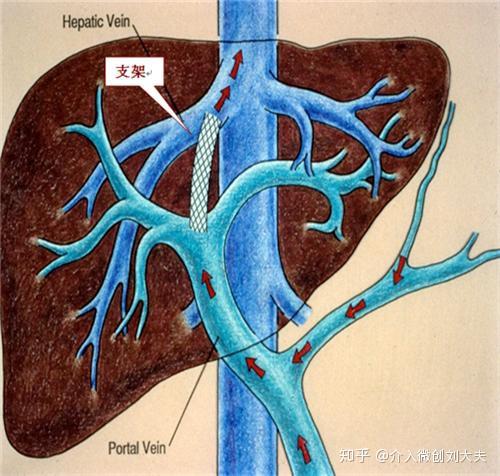 肝静脉与门静脉之间穿刺,建立 门体分流通道以降低门脉压力,控制食管