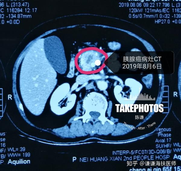 患者6月份复查ct,显示病灶有坏死,肿瘤未发展.