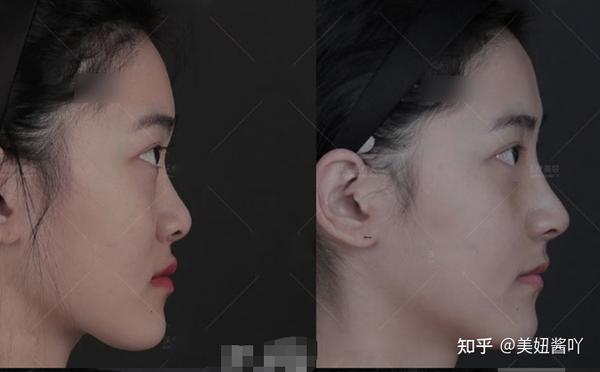 (2)上颌骨发育正常,但是上牙槽轻微前突(即轻度嘴凸)
