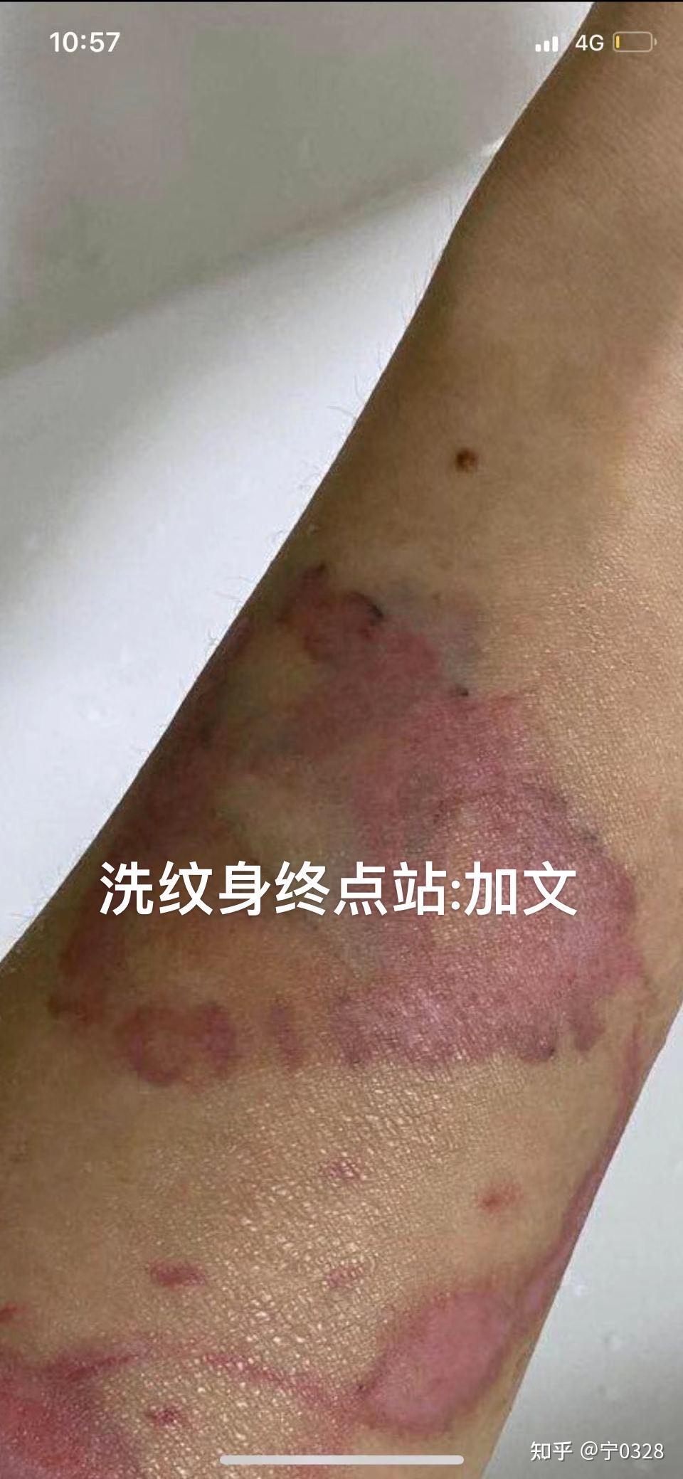 我想洗纹身在北京不知道哪能洗有知道的吗