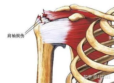 上海十院骨科虹桥院区专家讲述肩袖损伤