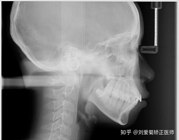 只是牙齿矫正,为什么要拍x光片,ct?