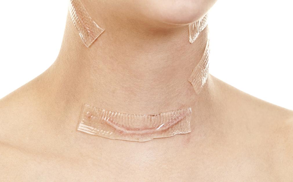 颈部甲状腺手术美容缝合