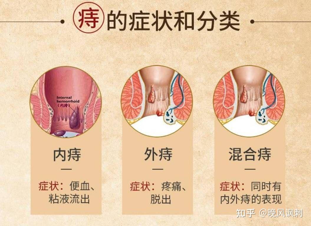 割痔疮你后悔了吗