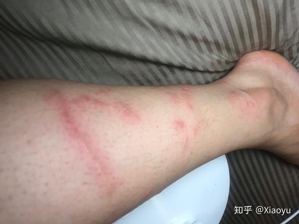 被水母蛰是一种什么体验?