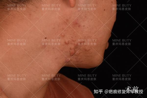 痘痘引发的疤痕疙瘩/瘢痕疙瘩该如何治疗?