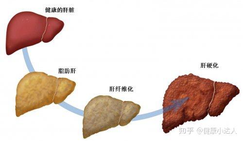 吃素也会得脂肪肝?那该如何是好?