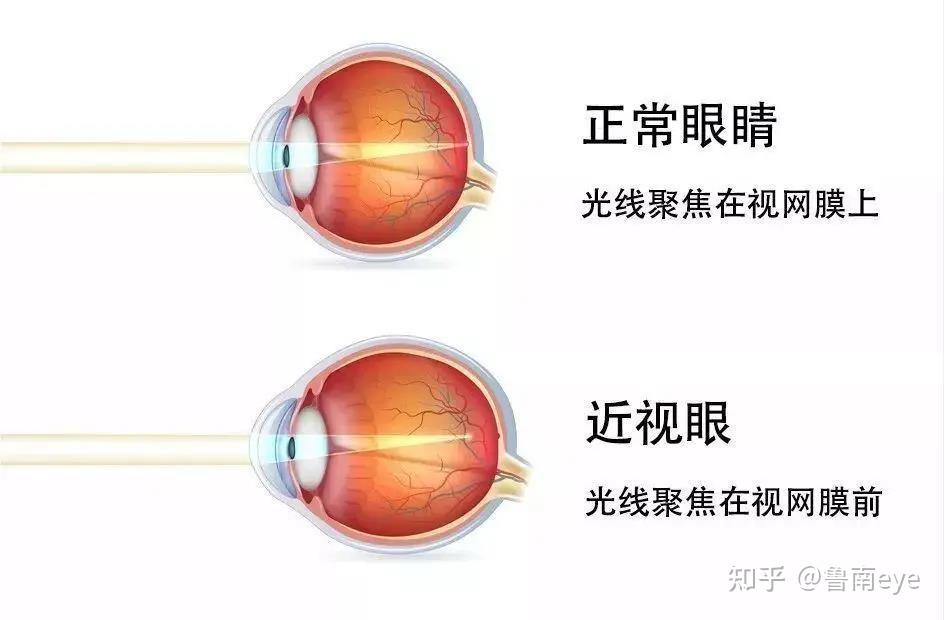 近视的发生主要与眼球前后轴长度过度拉长有关.