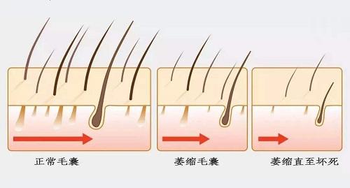 毛囊萎缩vs毛囊闭合毛囊出现问题该怎么办