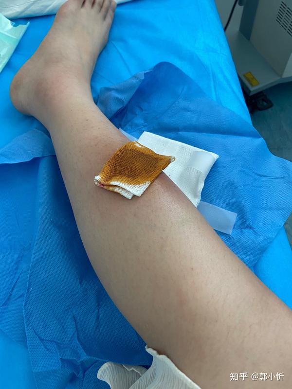 小腿火疖子从发展到切开全过程记录