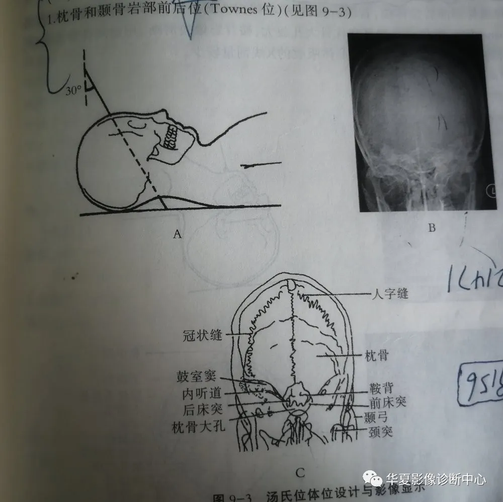 放射医学影像领域,医学知识交流分享 1 人 赞同了该文章 鼻旁窦柯氏位