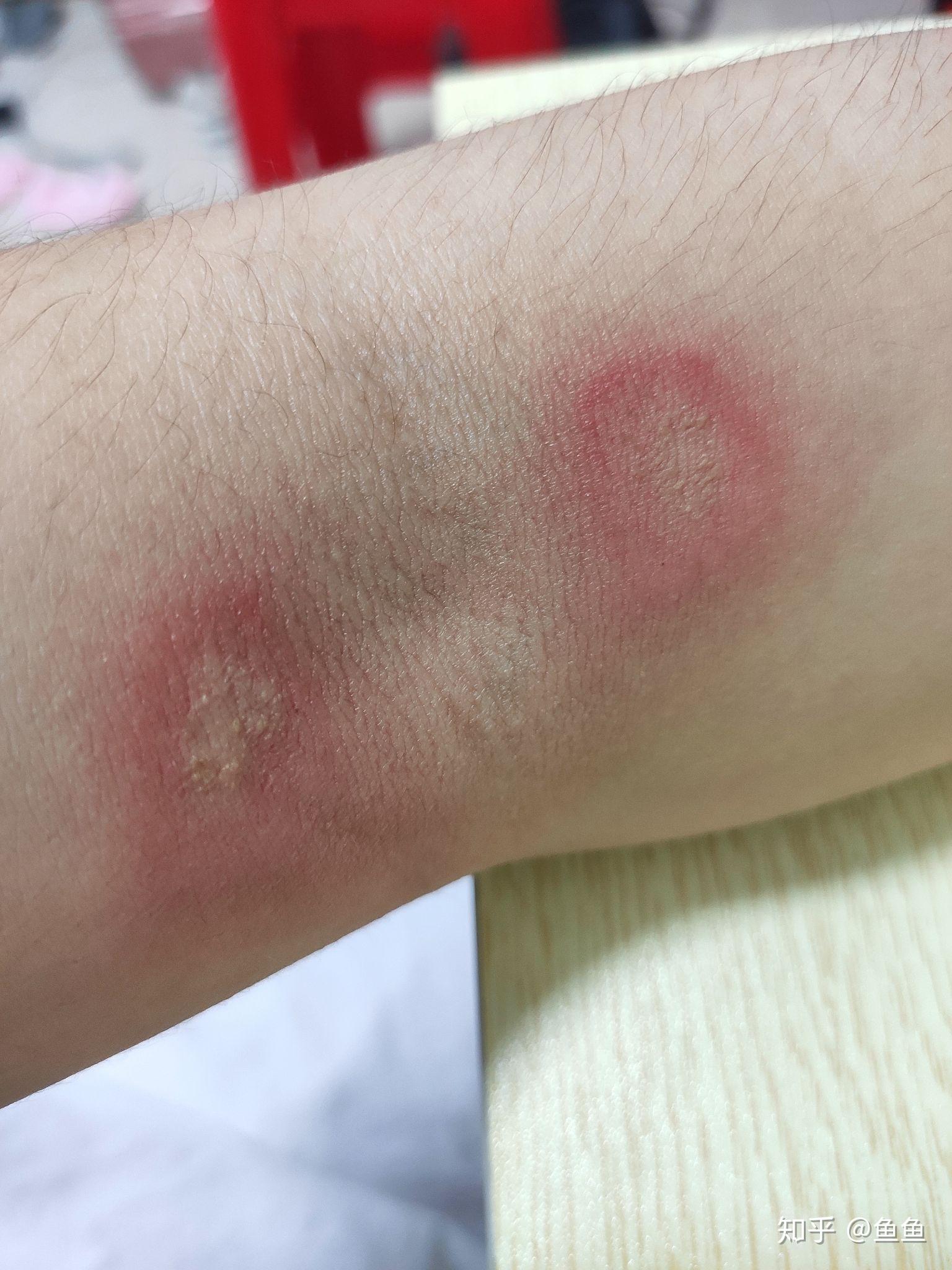 这是被虫子咬了吗就两天一开始以为是蚊子包然后有点刺痛但是不养