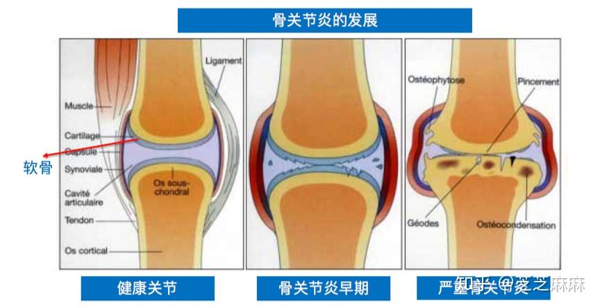 痛在关节病在软骨论胶原蛋白软骨素的重要性