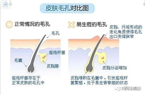 我的得力同盟(痤疮丙酸杆菌)是厌氧菌,厚厚的霜呀粉底呀盖住皮肤,正好