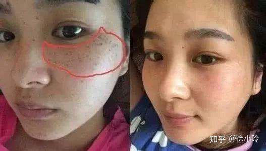 鼻子长斑是肝胆不好,嘴唇长斑是肾不好,脸上长斑是什么?