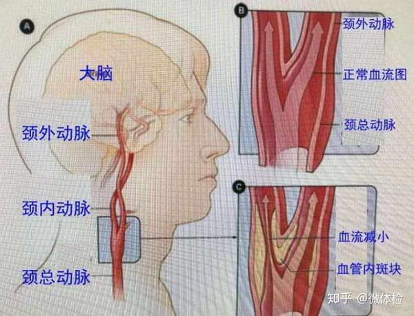 为什么颈部动脉最容易堵?