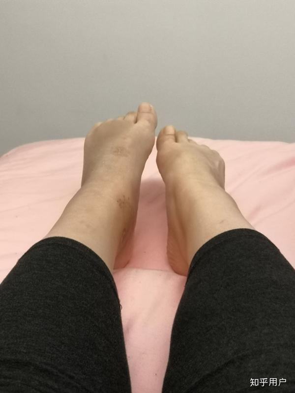 脚踝骨折怎么做才能恢复的快?