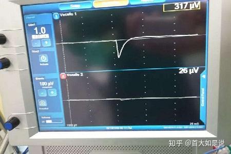 首大赵桂丽复杂甲状腺手术中喉返神经监测很重要