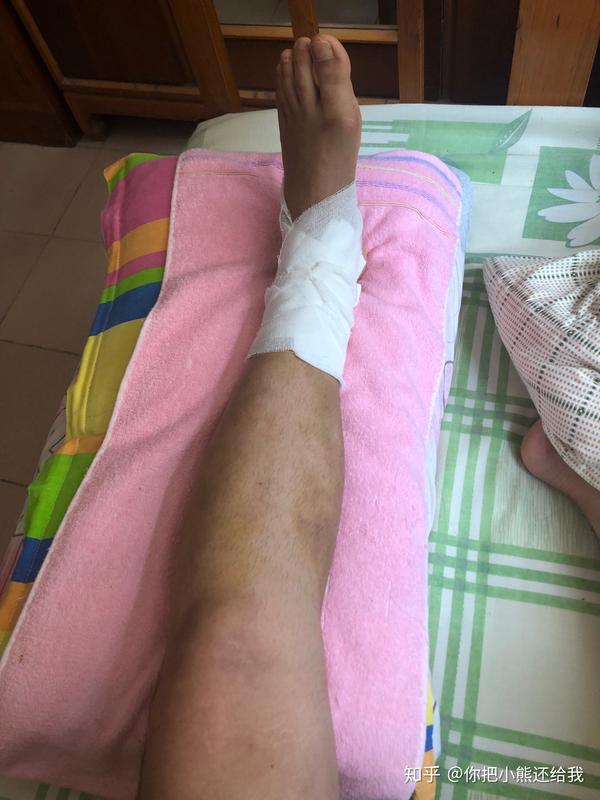 拆线完三天医生就让去了纱布,现在就是光脚躺在床上.