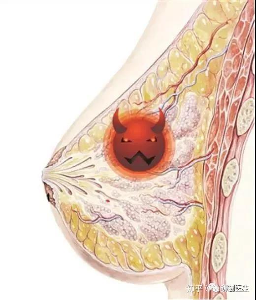 乳腺结节并不是一种疾病,而是一种症状,许多乳腺的病变都可表现为
