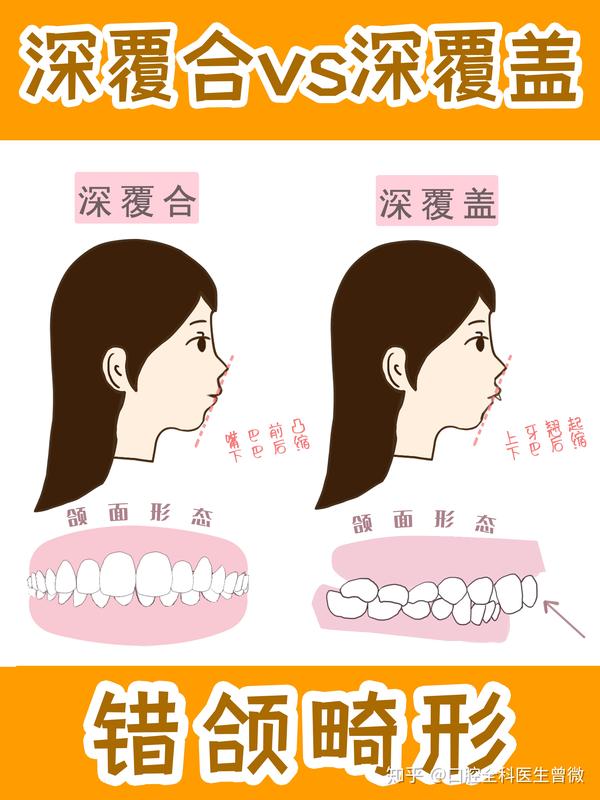 深覆合vs深覆盖,有什么区别吗?