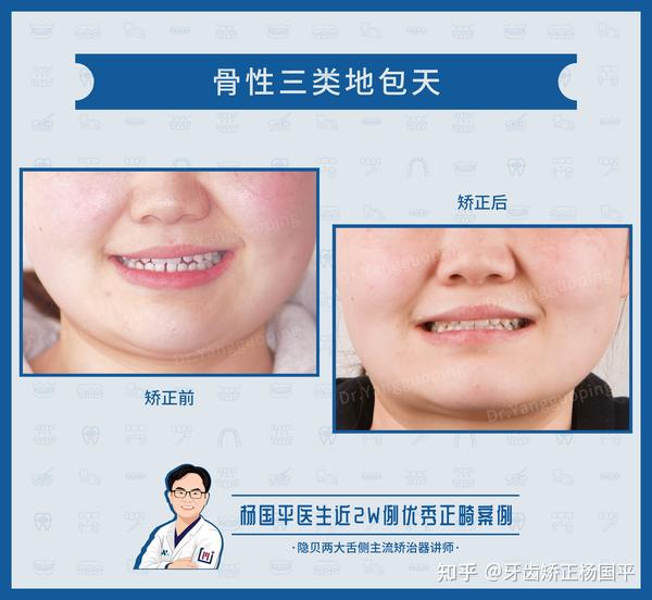 上海牙齿矫正:舌侧矫正地包天,片切挂三类牵引改善月牙面型