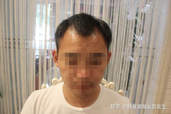 (图为某位发友脱发时所拍摄,从这个角度看,m字型还是很明显的)