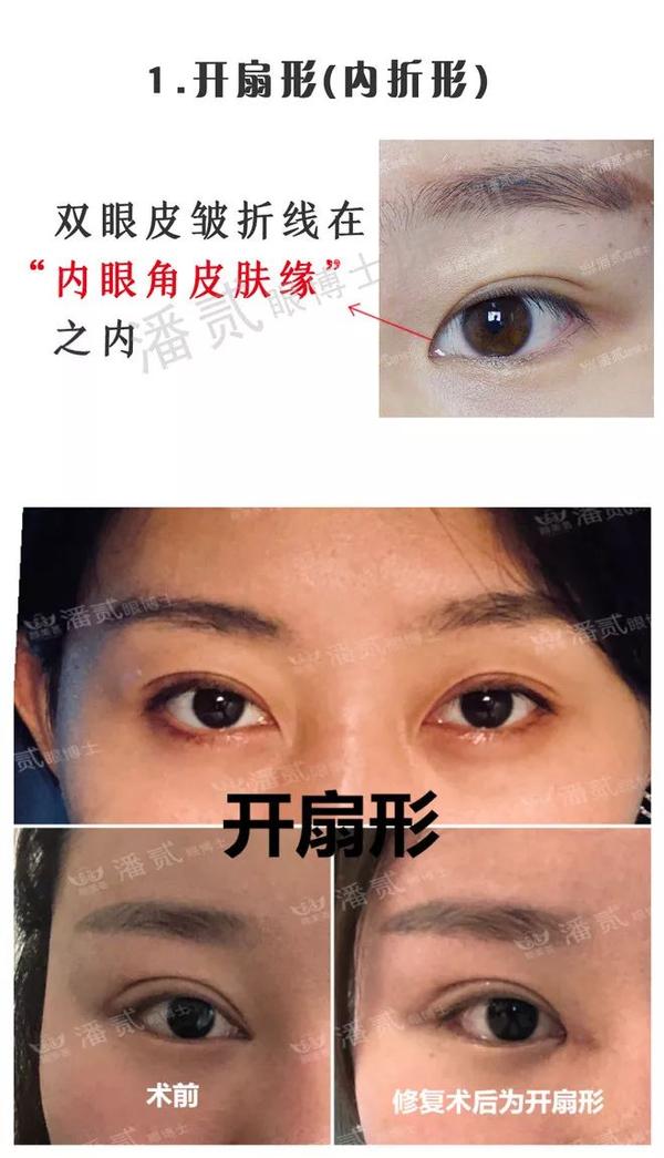 双眼皮形状分类!为什么不主张中国人做欧式平行双眼皮