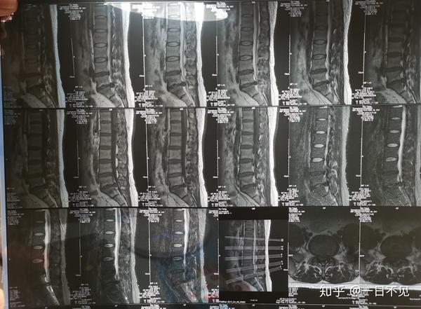 18日开始各种检查 心电图,x线,脑ct,腰椎ct,脑核磁,腰椎核磁,脑血流图