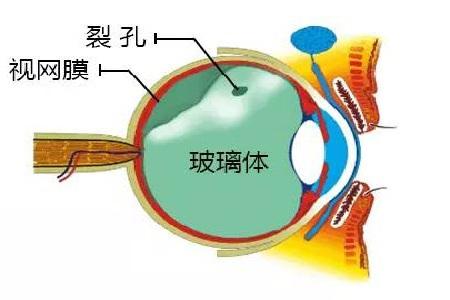 玻璃体后脱离会失明吗