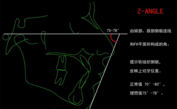 在tweed分析法中Z角是分析诊断中的第一顺序判断要素,这是以面型为