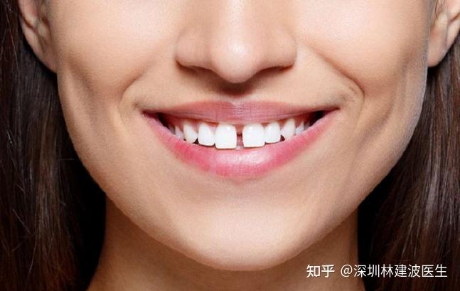 牙缝大容易导致牙齿脱落,这是真的吗?| 为什么会出现牙缝?