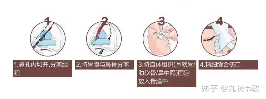 九院韦敏说为什么都说自体软骨隆鼻会成为鼻部手术重灾区呢