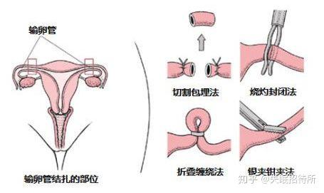 包括输卵管结扎(女性)和输精管结扎(男性),原理是用各种办法把输卵管