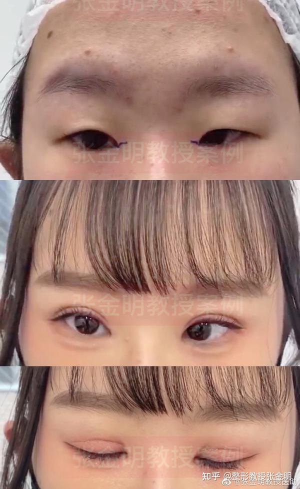 先天性小眼症可以矫正吗?