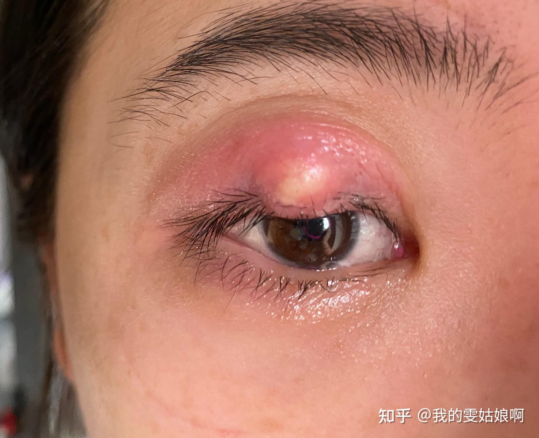 有没有得过外麦粒肿的朋友怎么个痊愈过程