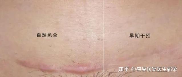 女性剖腹产后的疤痕用不用治疗