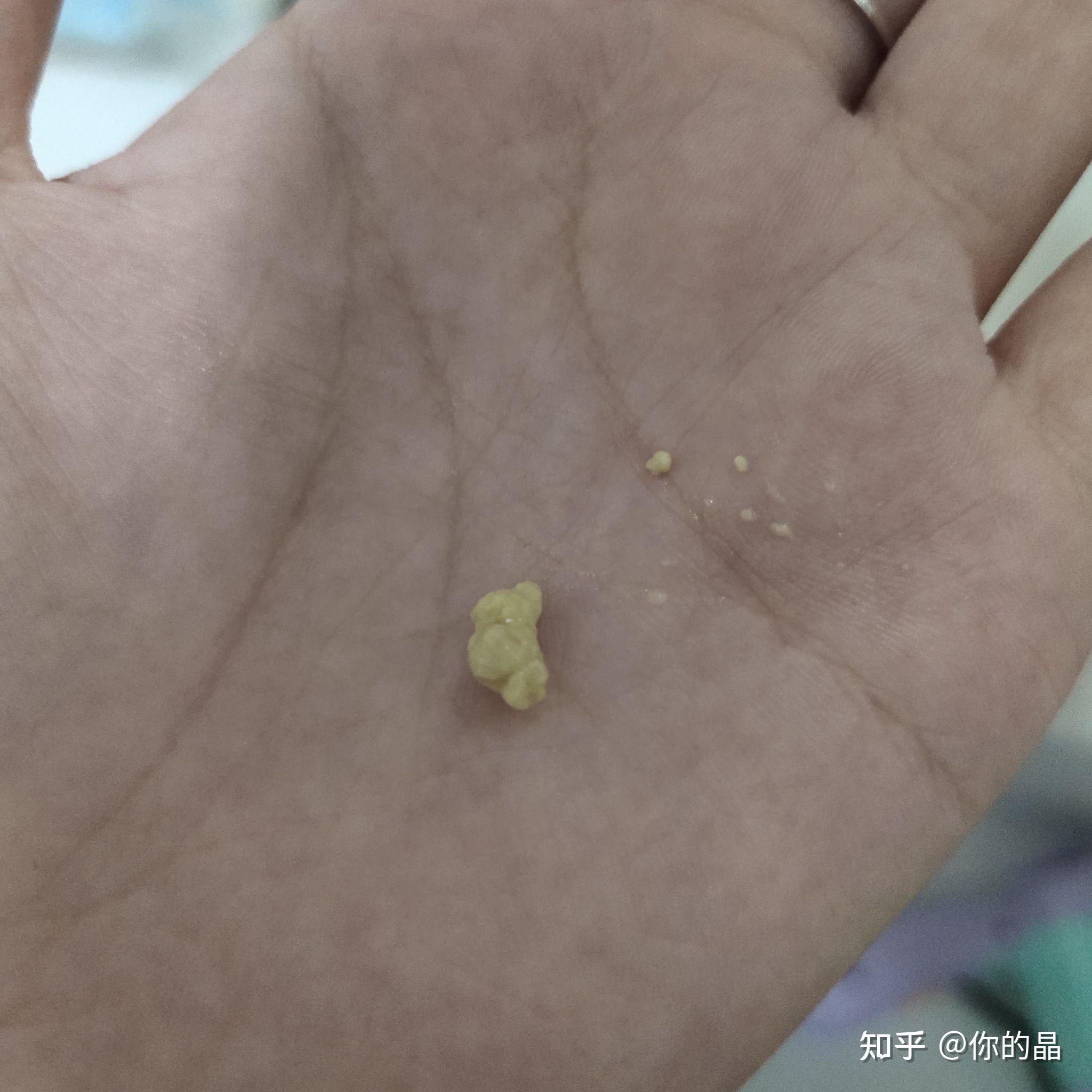 你见过最大的扁桃体结石有多大?