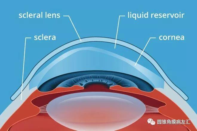 巩膜镜接触镜系列文章