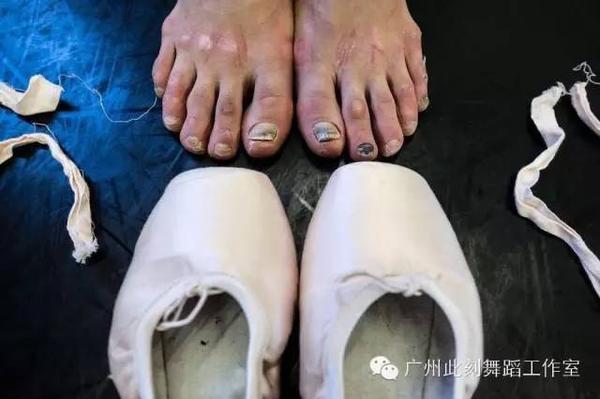 如何评价芭蕾舞演员为了艺术把脚练的变形?
