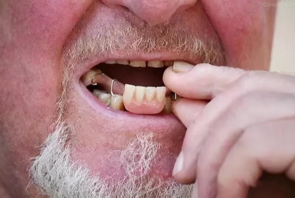 假牙手可剁牙齿不能掉你了解过种植牙吗